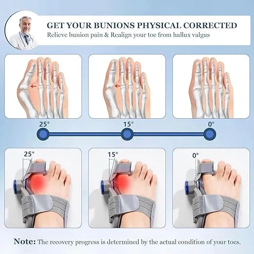 FeetifFix - Bunion Corrector